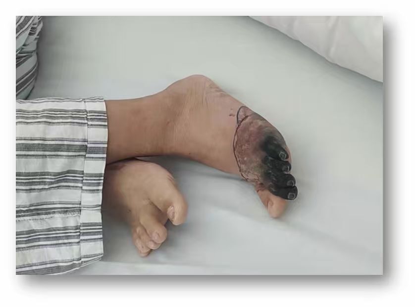 流脑病例足部坏死样病变(湖南省疾病预防控制中心提供).jpg