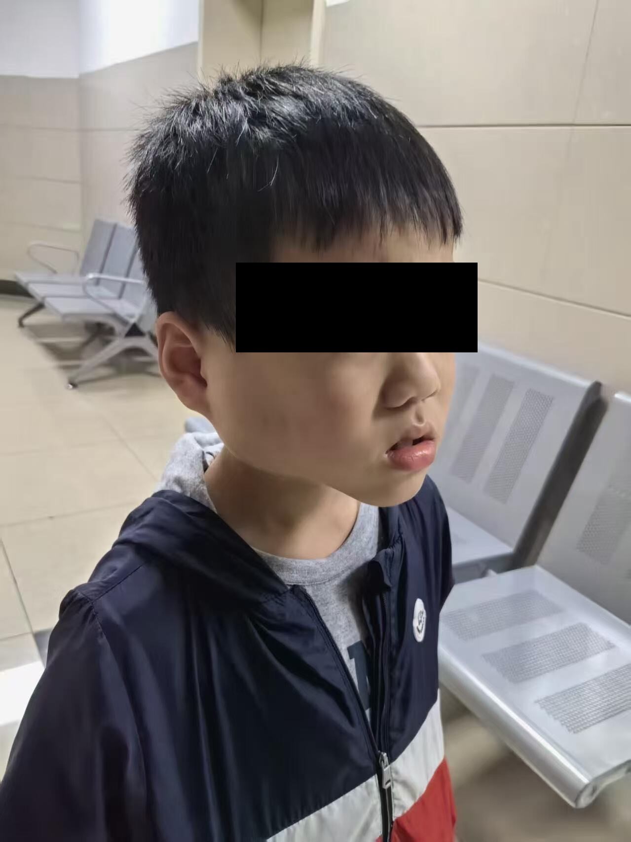 流行性腮腺炎病例腮腺肿大(图2)(贵阳市公共卫生救治中心提供).jpg